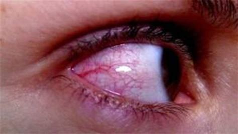 What to Do About Red Veins on the Whites of the Eyes - YouMeMindBody