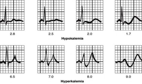 Hyperkalaemia Clinical Case • LITFL • Clinical case