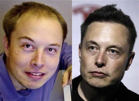 Elon Musk a-t-il subi une greffe de cheveux ? - İberia Clinic