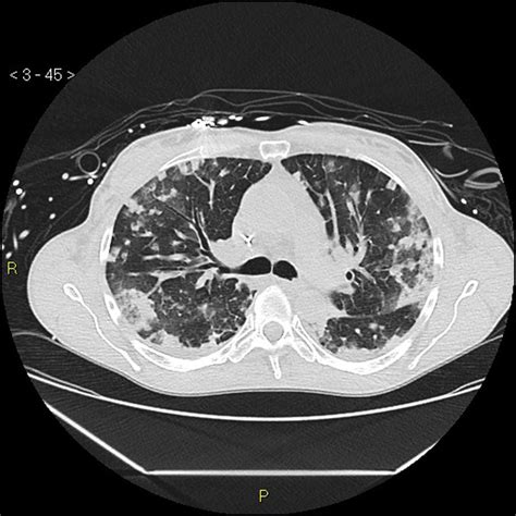 Ards Chest X Ray Findings