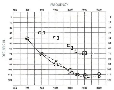 Audiograms | Aussie Deaf Kids