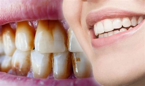 How to remove brown stains from teeth | Express.co.uk