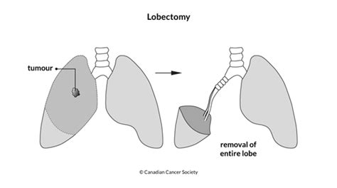 Surgery for non–small cell lung cancer | Canadian Cancer Society