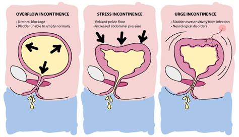 What is the Most Common Cause for Urge Incontinence? - Pharma Mirror Magazine