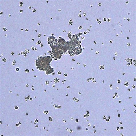 Ammonium biurate (urate) or xanthine crystals in urine from an English bulldog. The dog had been ...