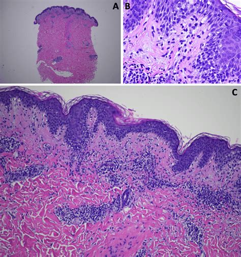 Histopathology showing spongiosis, mild lymphocytic exocytosis with... | Download Scientific Diagram