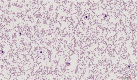 Beta Thalassaemia Intermedia | LearnHaem | Haematology Made Simple