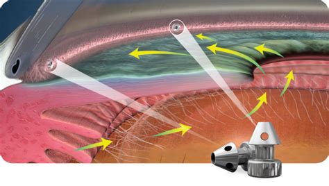 Minimally Invasive Glaucoma Surgery (MIGS) - Azar Eye Clinic