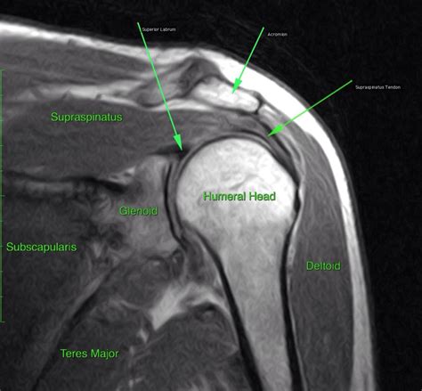 MRI AP shoulder. Unidad Especializada en Ortopedia y Traumatologia en Bogota - Colombia PBX ...