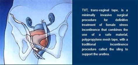 Trans Vaginal Tape Surgery India - Low Cost Trans Vaginal Surgery in India