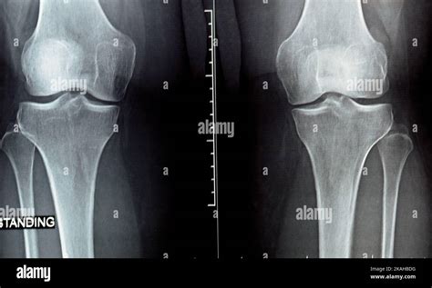 plain x ray on knee joint showing joint space narrowing and Subchondral ...