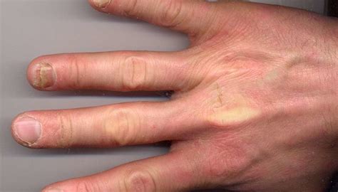 Psoriatic arthritis and nails: Changes, pictures, and treatment