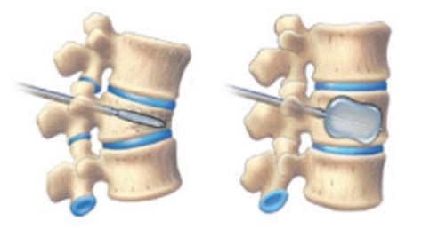 Spine Fractures - Surrey Orthopaedic Clinic