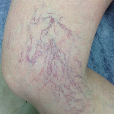 What are Spider Veins? — The Leg Vein Doctor | Brisbane | Varicose and Spider Vein Phlebology Clinic