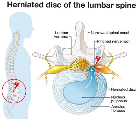 Treatment for Herniated Disc | Premia Spine Blog