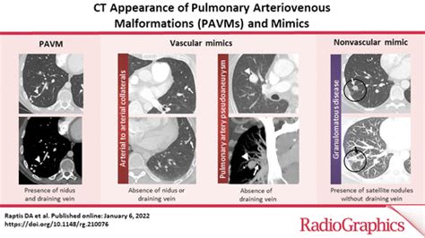 CT Appearance of Pulmonary Arteriovenous Malformations and Mimics | RadioGraphics