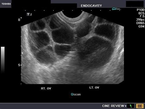 Theca Luteum Cyst