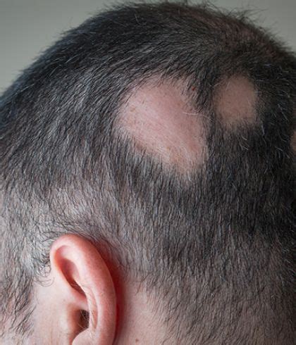 What causes Alopecia Areata in Men? | Dr Batra’s™ Homeopathy in Dubai