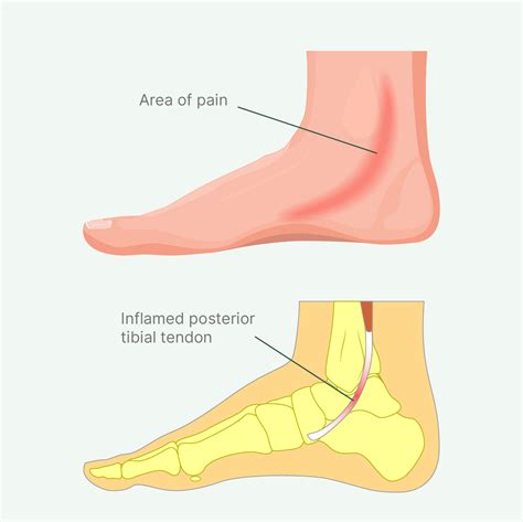 Tibialis Anterior Foot Pain