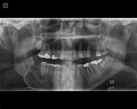 What is an OPG X-ray? | Top Doctors