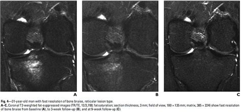 Bone bruise - Physiopedia