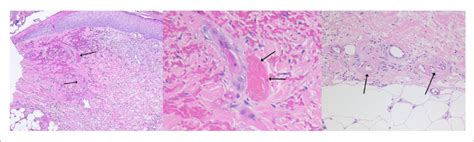 Histopathology of livedoid vasculopathy skin lesions. Left: Livedoid... | Download Scientific ...