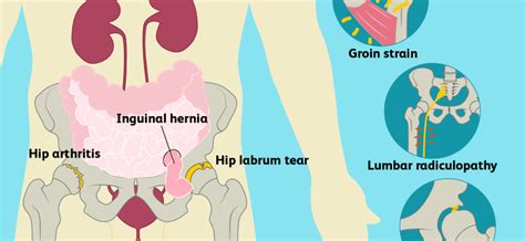 Groin pain – causes. When is pain in the left and right groin ...