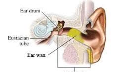 Ear wax impaction treatment – Soda glycerin 3-4 drops two times a day