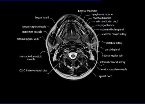 MRI neck anatomy | free MRI axial neck cross sectional anatomy ...