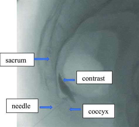 Ganglion impar block with fluoroscopy | Download Scientific Diagram