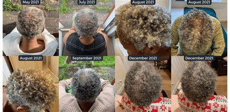 Black Seed Oil Hair Growth Before And After – Equi Botanics