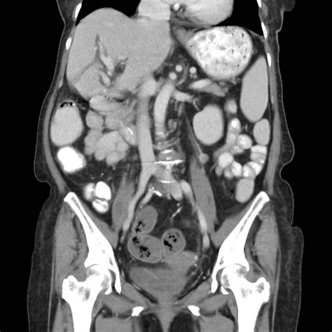 Transverse colon cancer and gastric GIST | Image | Radiopaedia.org