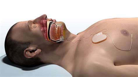 FDA Approves Implanted Device for Sleep Apnea | Sleep Review