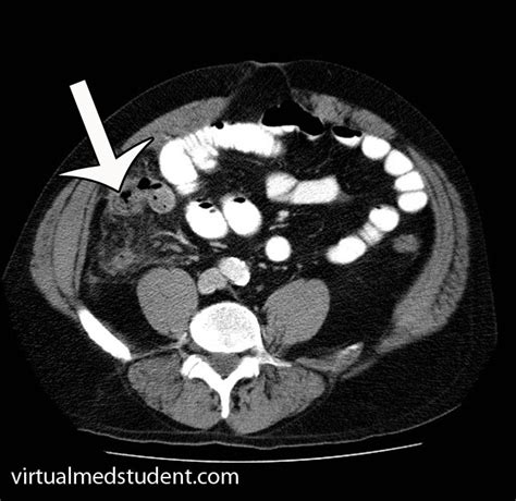 VirtualMedStudent.com || Daily Diagnosis Appendicitis