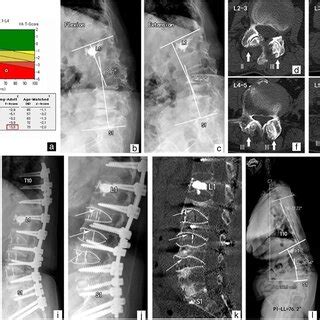 Example of a patient who underwent deformity correction surgery using... | Download Scientific ...