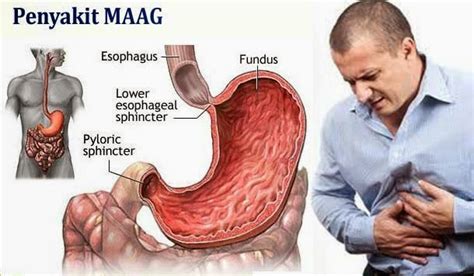 Gejala Penyakit Maag Kronis dan Cara Pengobatan Sistem Herbal