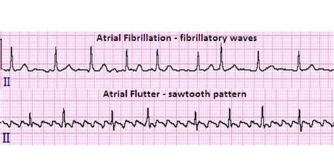 A flutter ekg - gulfbabe