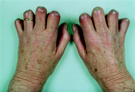 Treatment of cutaneous calcinosis in limited systemic sclerosis with ...