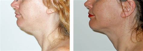 Chin Lipo By Dr. Landon D. McLain, MD, DMD, FACS, Huntsville AL Plastic ...