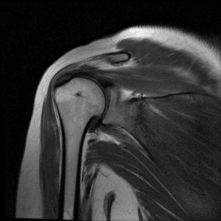 Acromion fracture | Radiology Reference Article | Radiopaedia.org