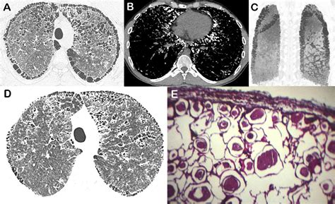 Exuberant Paraseptal Emphysema Associated With Pulmonary Alveolar ...