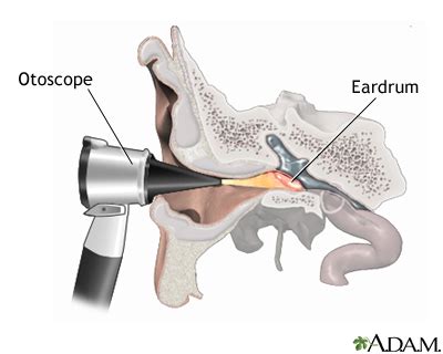 Otoscopic exam of the ear: MedlinePlus Medical Encyclopedia Image