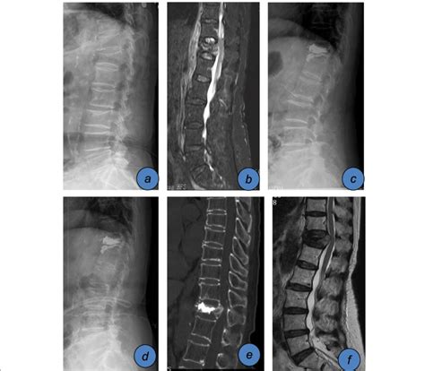 An 80-year-old female patient with thoracic 12 vertebral compression ...