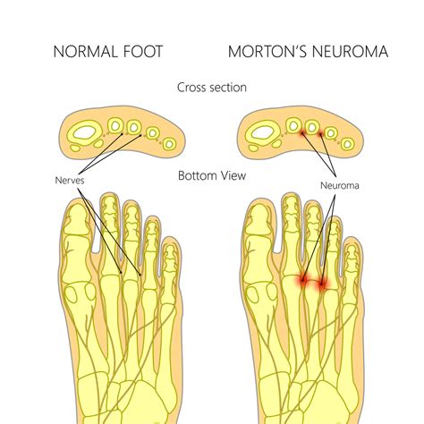 Mortons Neuroma Brisbane - Resolve Neuroma, No surgery 3003 0801