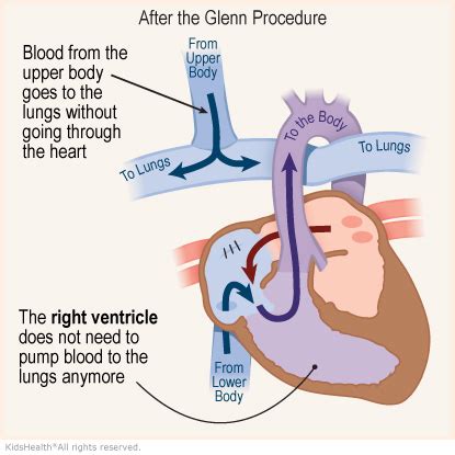 The Glenn Procedure (for Parents) | Nemours KidsHealth