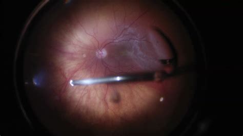 Retinal Surgery - Med X Change EvolutionHD - Med X Change - HD Surgical ...