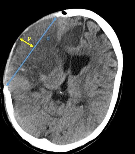 External brain herniation and decompression size assessed on ...