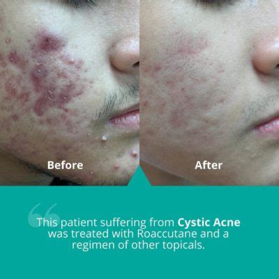 Accutane Before and After: Remarkable Skin Transformations ...