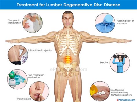 Types of Degenerative Disc Disease & Its Symptoms, Treatment ...