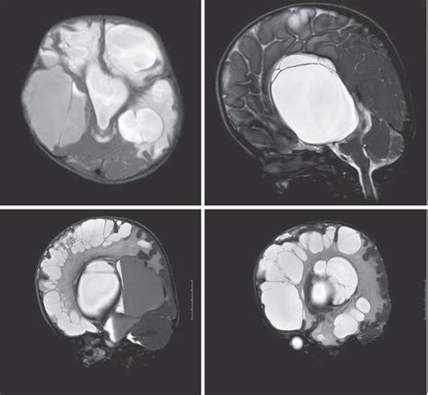 Neurosurgery at Nimhans: Haustra Cerebri